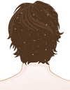 ¿Por qué aparece la caspa? Las causas más comunes de la caspa en el pelo