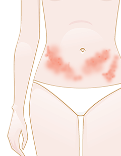 Consejos para tratar el herpes zóster
