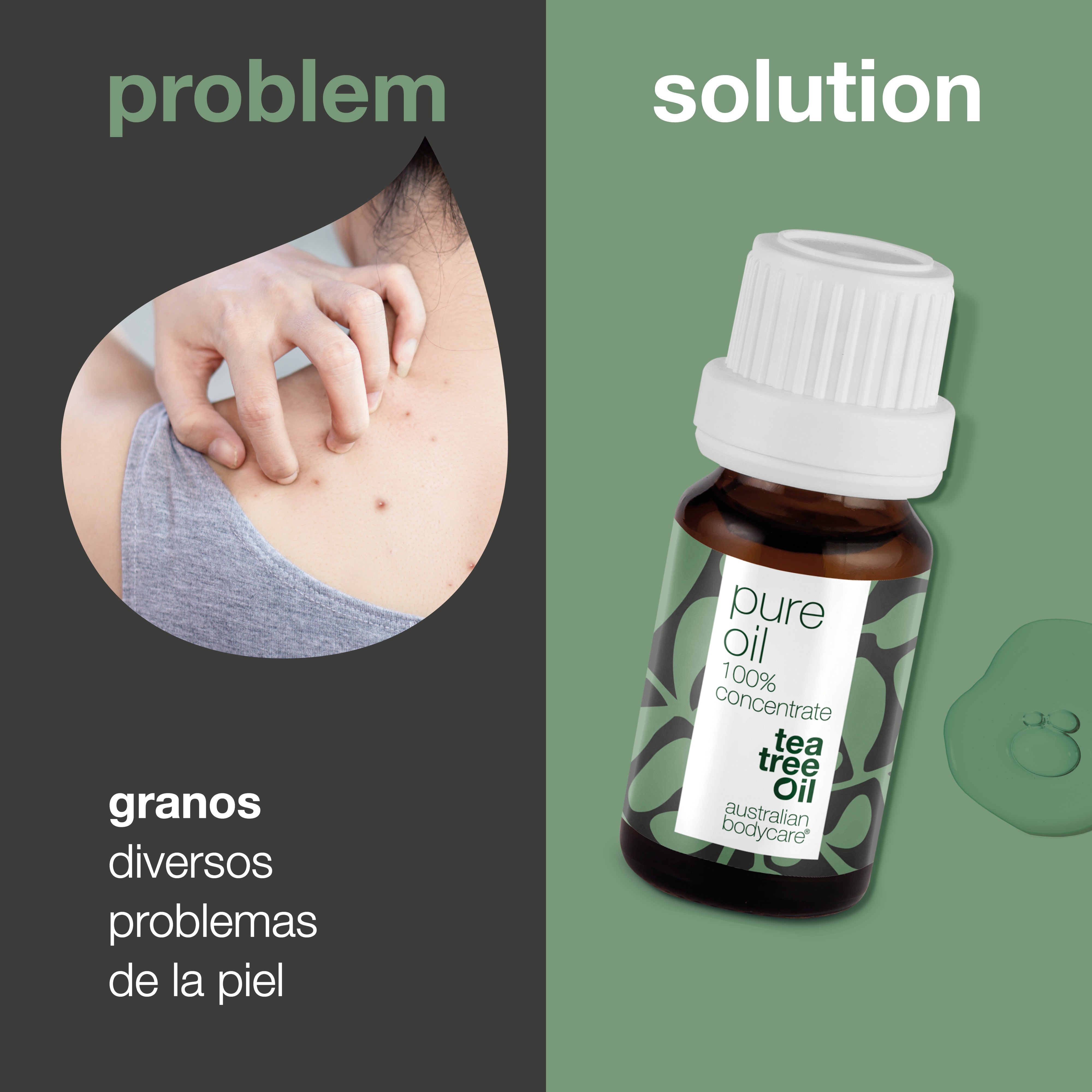 Aceite puro de árbol de té para problemas de la piel: aceite de árbol de té 100% natural y concentrado de Australia
