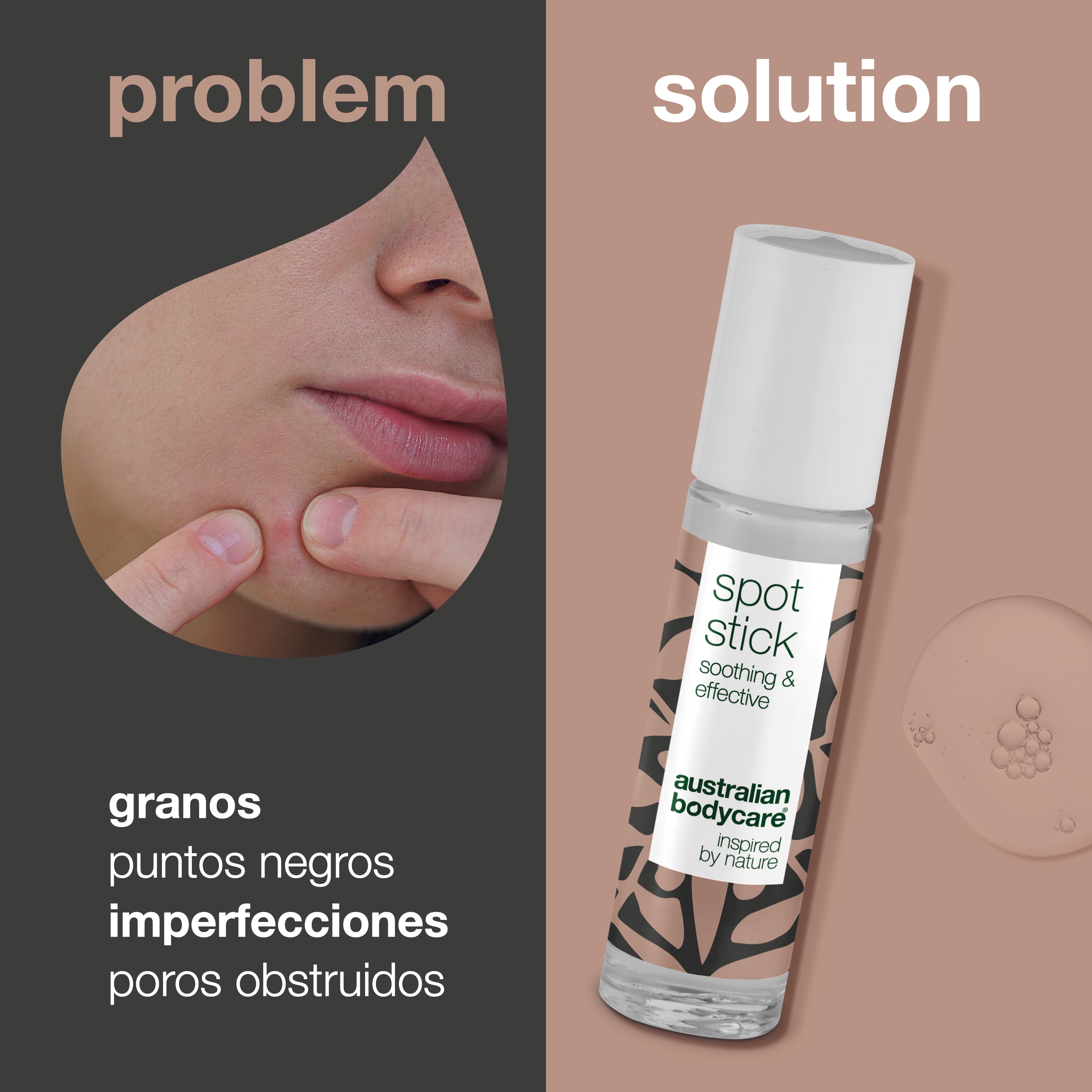 Tratamiento localizado con aceite de árbol de té para pieles congestionadas: para el cuidado diario del acné y eficaz contra la piel con imperfecciones, espinillas y puntos negros.