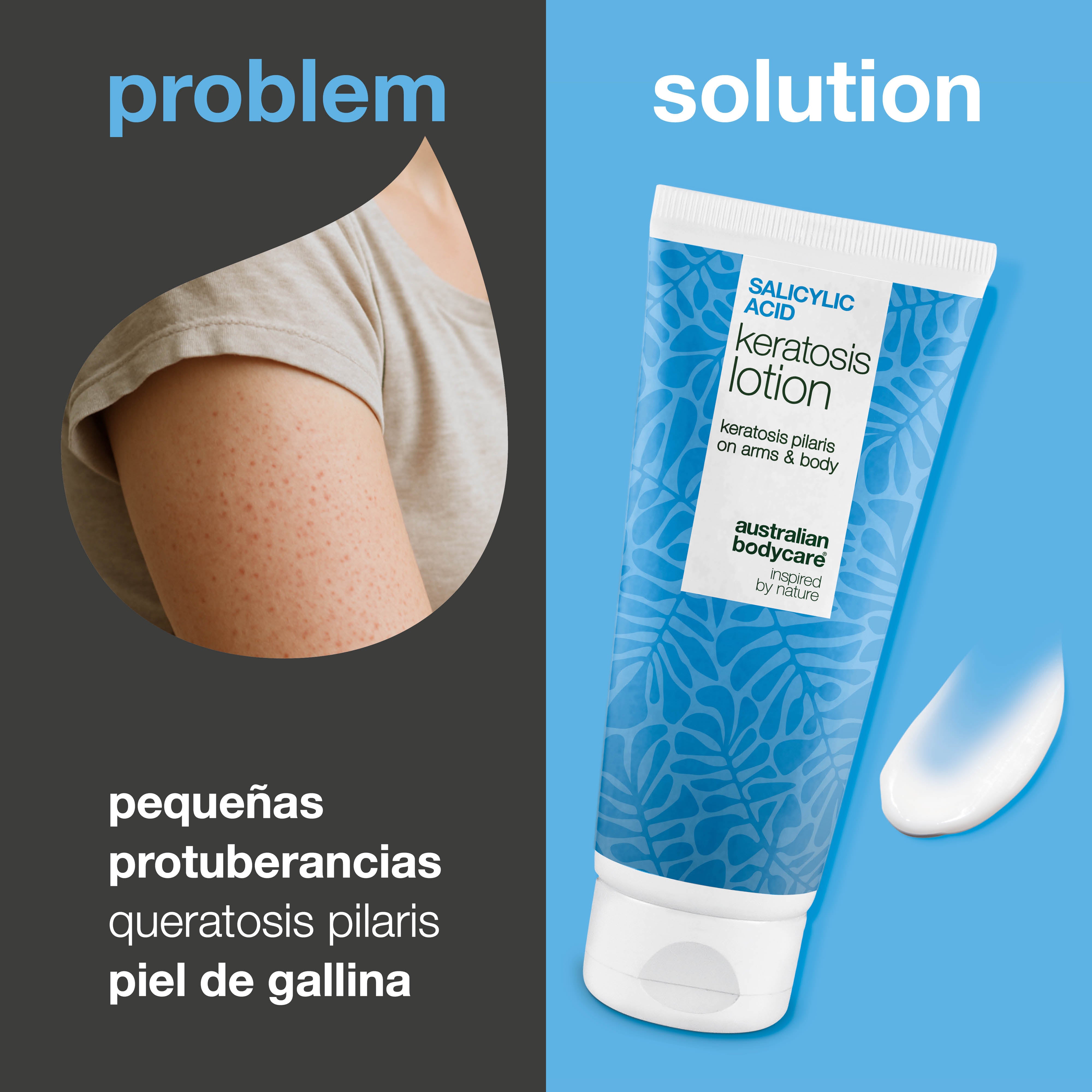 Loción corporal para queratosis pilaris y sequedad — Loción para queratosis pilaris. Suaviza y calma con ácido salicílico, niacinamida y zinc. Ideal para piel seca y rugosa.