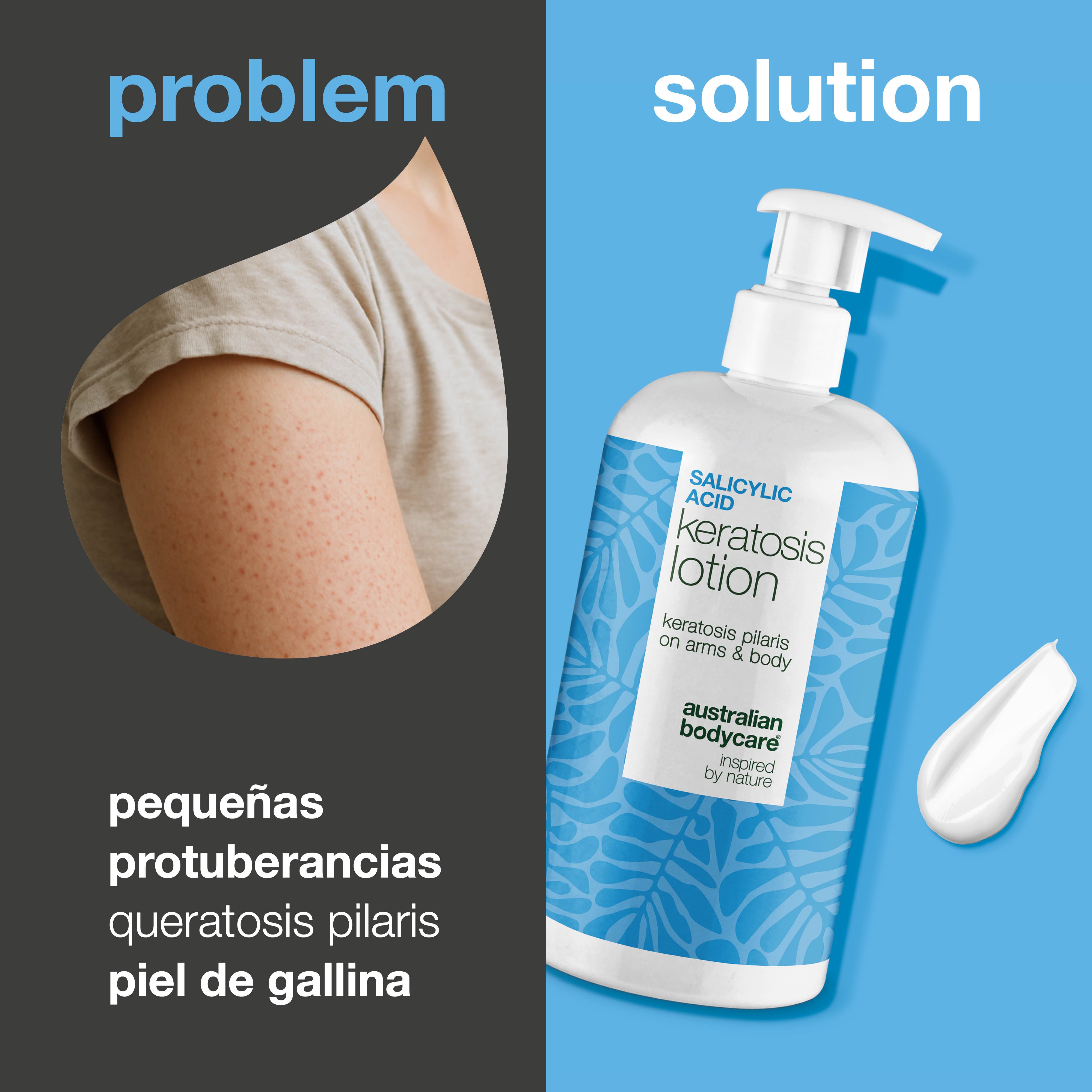 Loción corporal para queratosis pilaris y sequedad — Loción para queratosis pilaris. Suaviza y calma con ácido salicílico, niacinamida y zinc. Ideal para piel seca y rugosa.