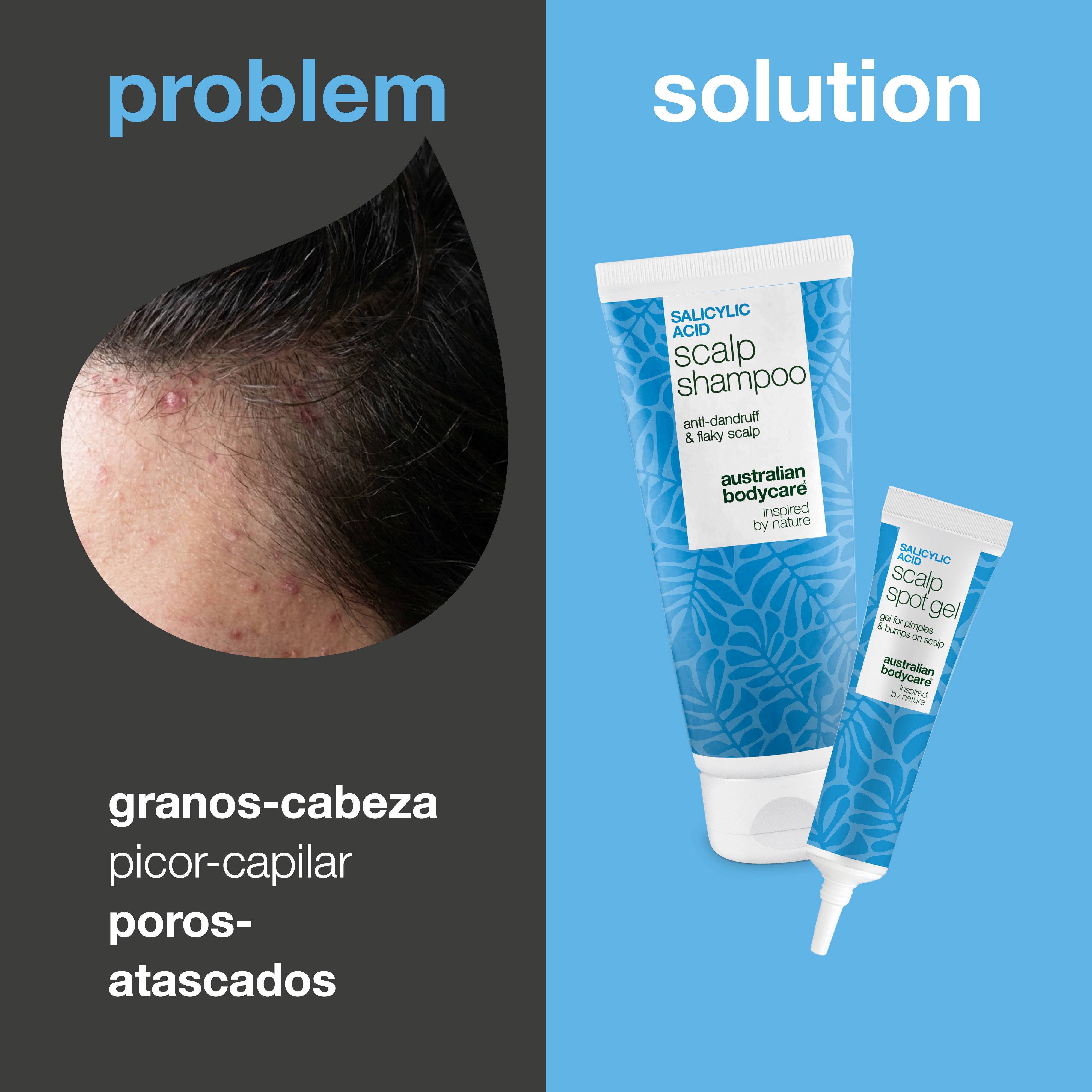 Problema y solución: primer plano de granos y bultitos en el cuero cabelludo junto al champú y gel del set