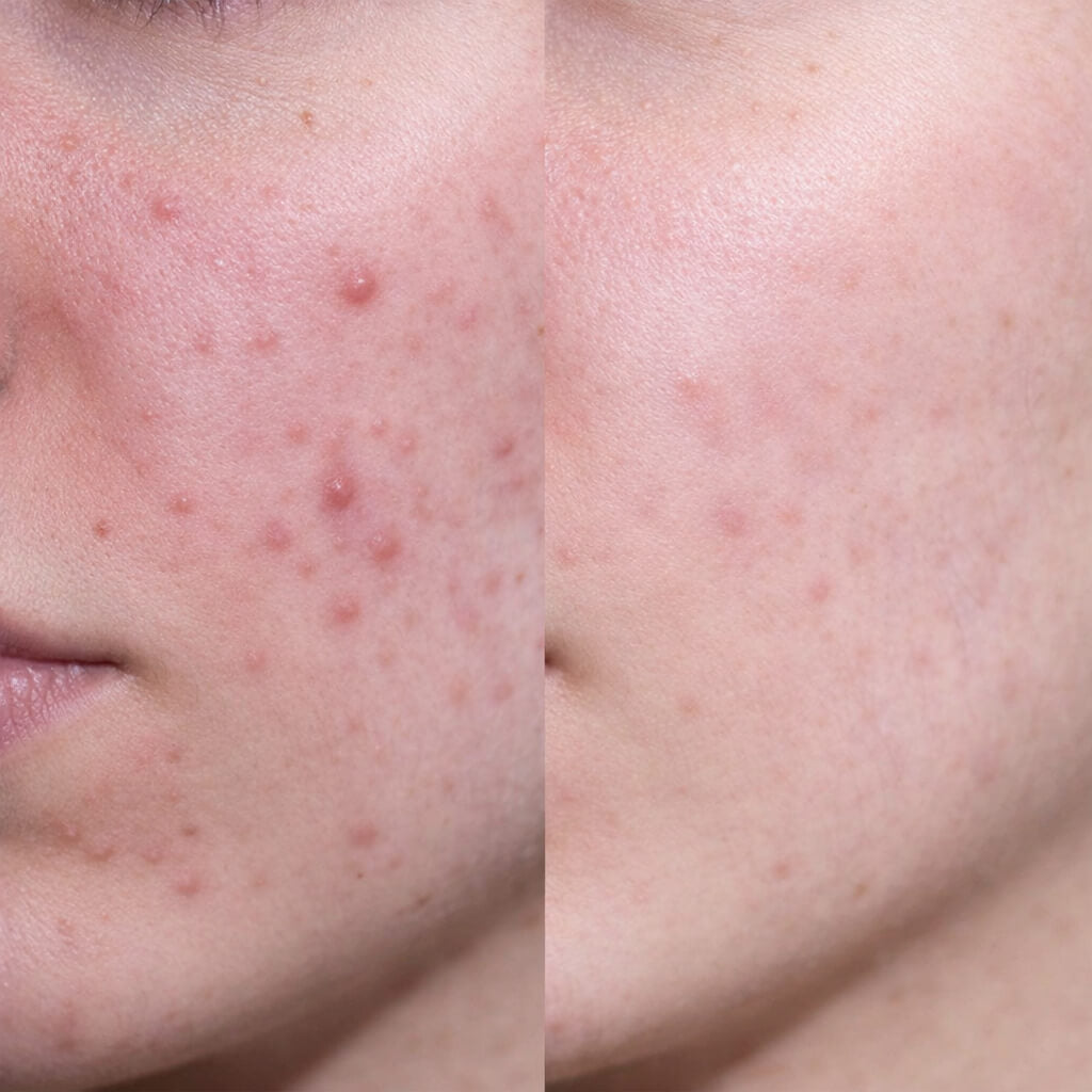 Imagen de antes y después de un cliente que muestra una piel más limpia, con menos granos y rojeces tras usar crema facial con ácido salicílico.