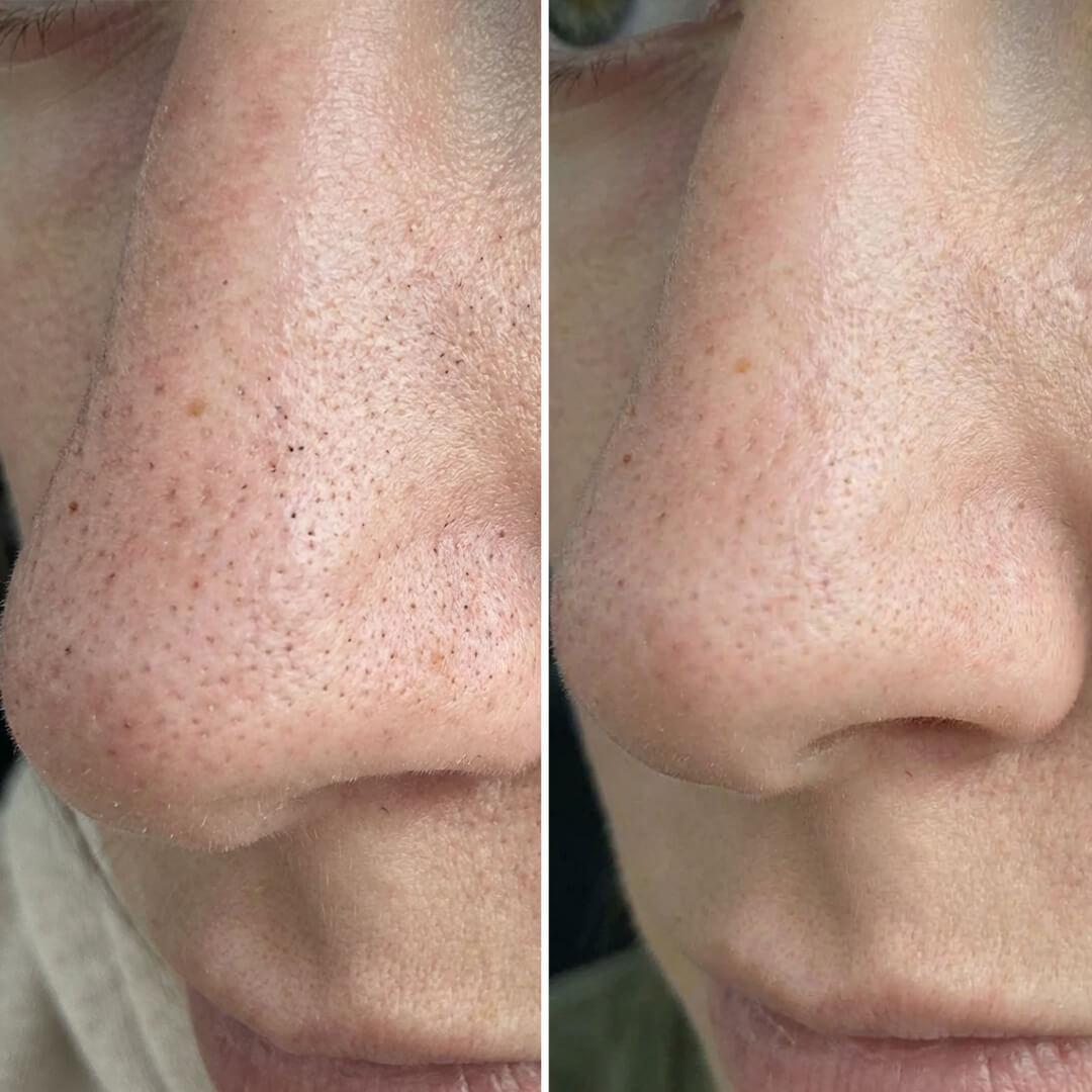 Set contra puntos negros y poros obstruidos con ácido salicílico – limpieza profunda para una piel uniforme