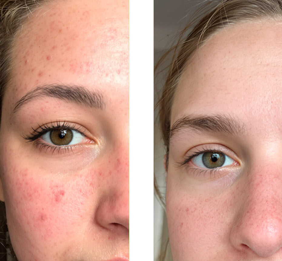 Imagen de antes y después de un cliente usando nuestro Tónico/Peeling/Exfoliante facial con ácido salicílico al 2%, mostrando una gran mejora en la piel con menos granos e imperfecciones.