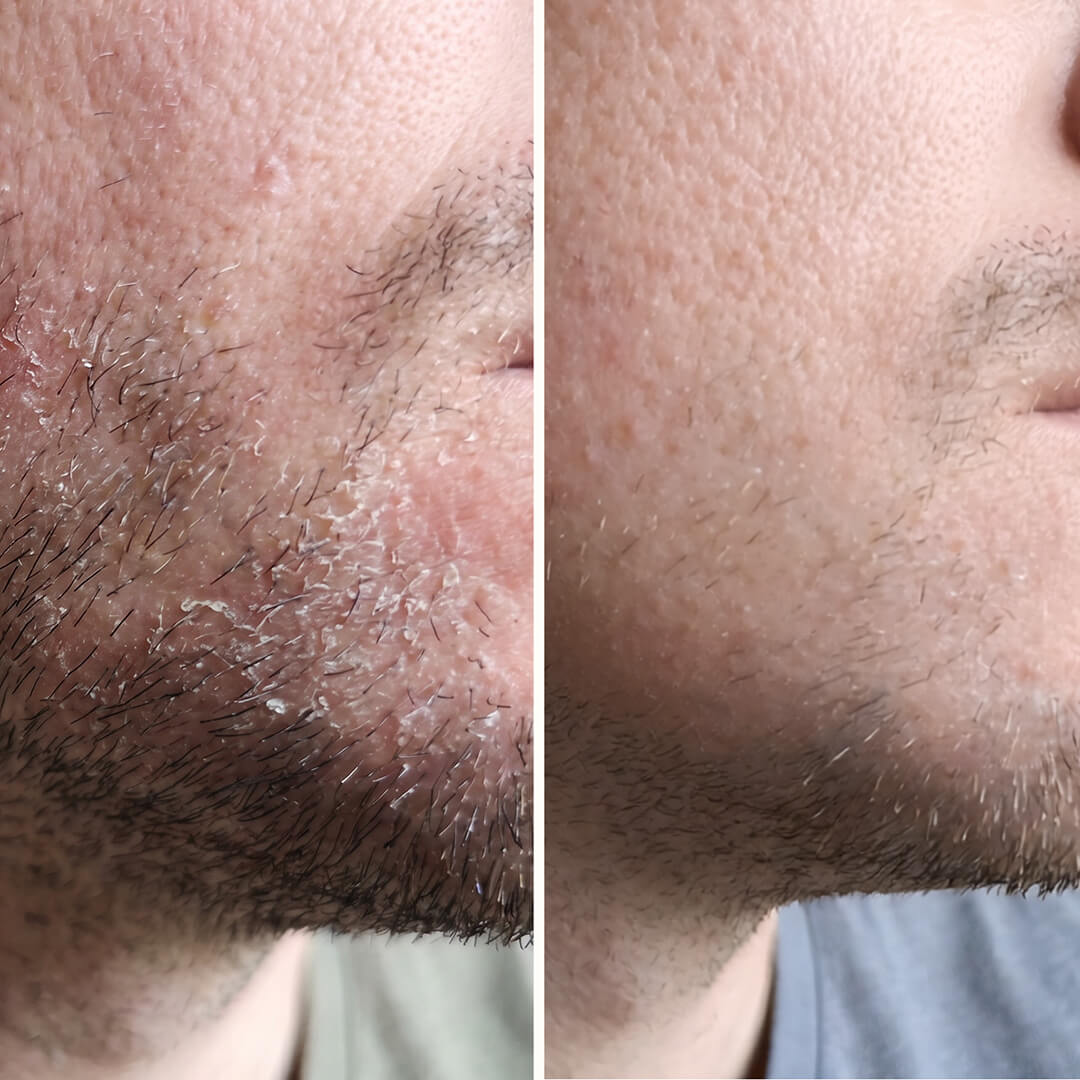 Sérum Ácido Salicílico – Contra la caspa en cara y barba — Sérum eficaz contra la caspa facial y de la barba. El Ácido Salicílico elimina escamas y rojeces para restaurar el equilibrio de tu piel.