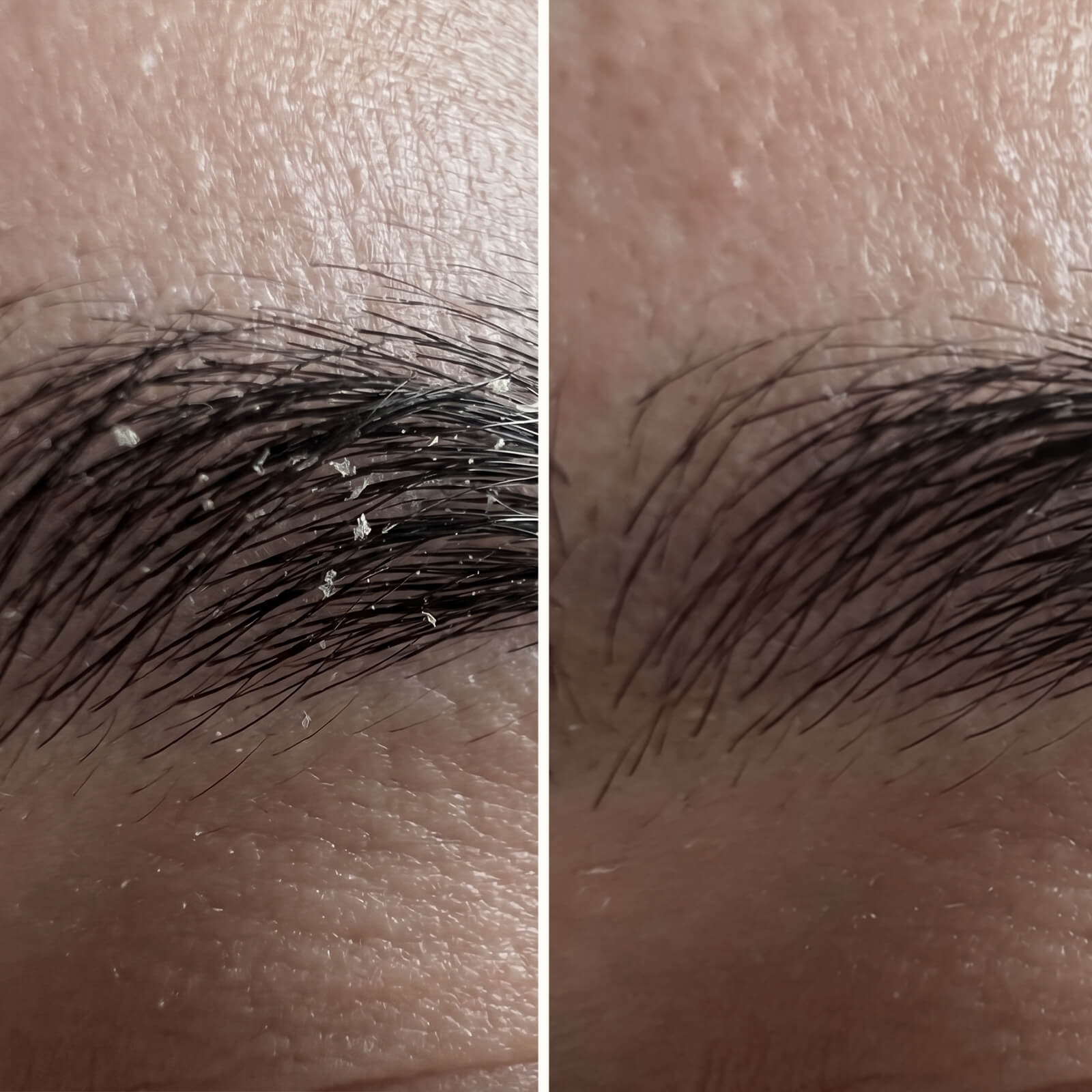 Sérum Ácido Salicílico – Contra la caspa en cara y barba — Sérum eficaz contra la caspa facial y de la barba. El Ácido Salicílico elimina escamas y rojeces para restaurar el equilibrio de tu piel.
