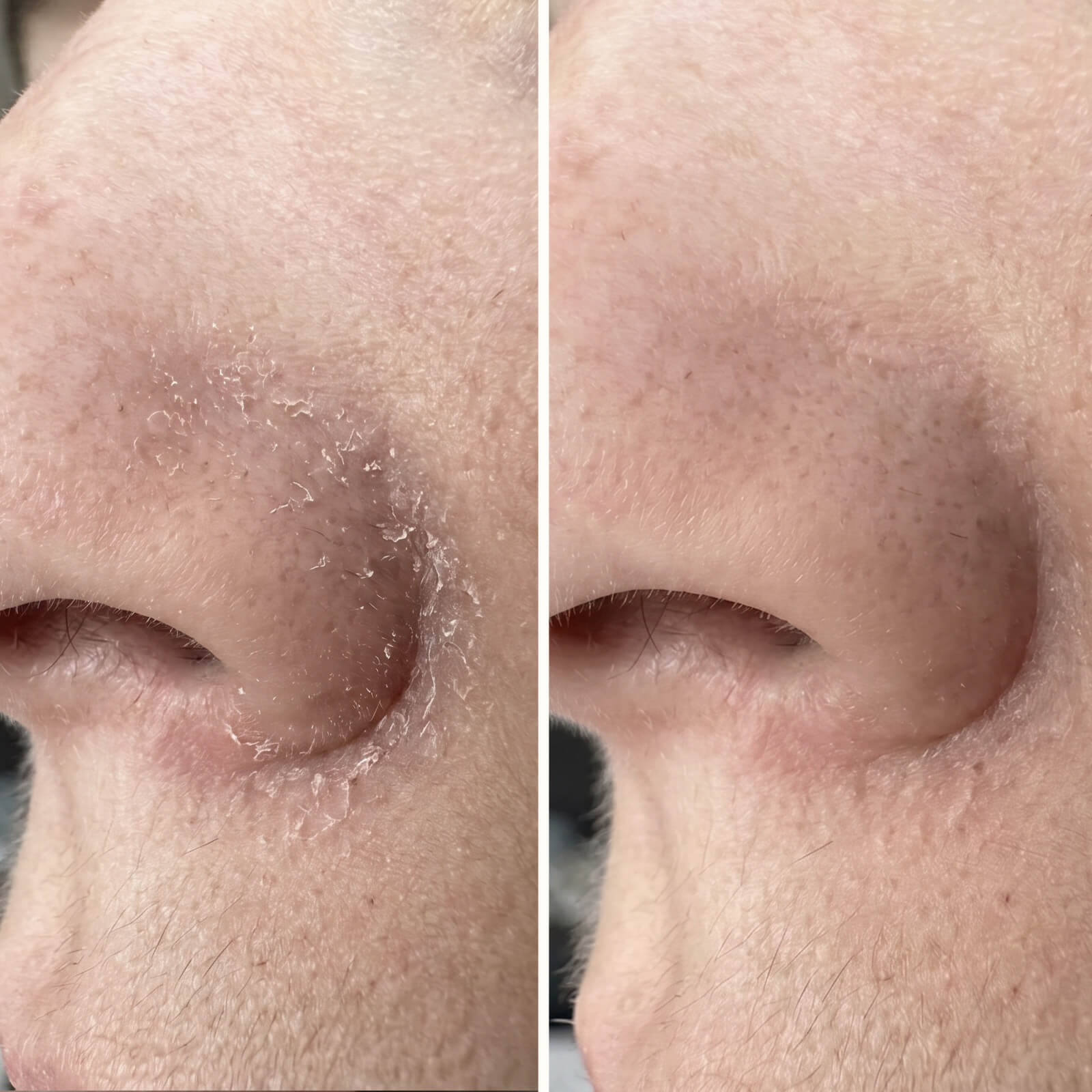 Sérum Ácido Salicílico – Contra la caspa en cara y barba — Sérum eficaz contra la caspa facial y de la barba. El Ácido Salicílico elimina escamas y rojeces para restaurar el equilibrio de tu piel.