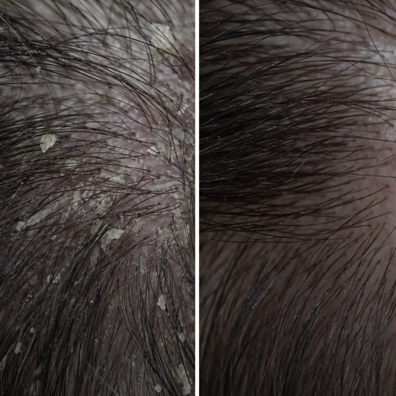 Tratamiento con ácido salicílico para caspa, picor y cuero cabelludo graso — Tratamiento con ácido salicílico para cuero cabelludo con caspa, picor y grasa. Exfolia suave y equilibra antes del lavado.