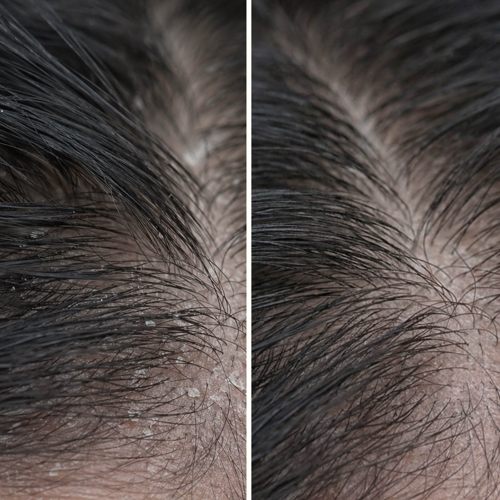 Tratamiento con ácido salicílico para caspa, picor y cuero cabelludo graso — Tratamiento con ácido salicílico para cuero cabelludo con caspa, picor y grasa. Exfolia suave y equilibra antes del lavado.