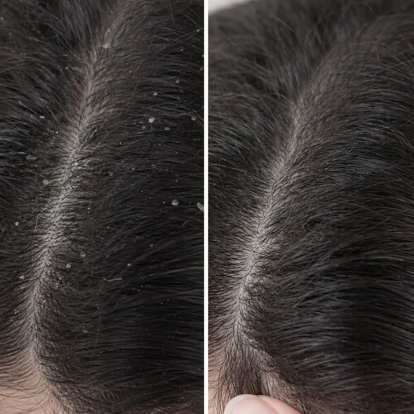 Acondicionador Ácido Salicílico: Caspa y picor del cuero cabelludo — Acondicionador con Ácido Salicílico contra la caspa e irritaciones. Hidrata y fortalece el cabello. Cuidado eficaz con Ácido Salicílico.