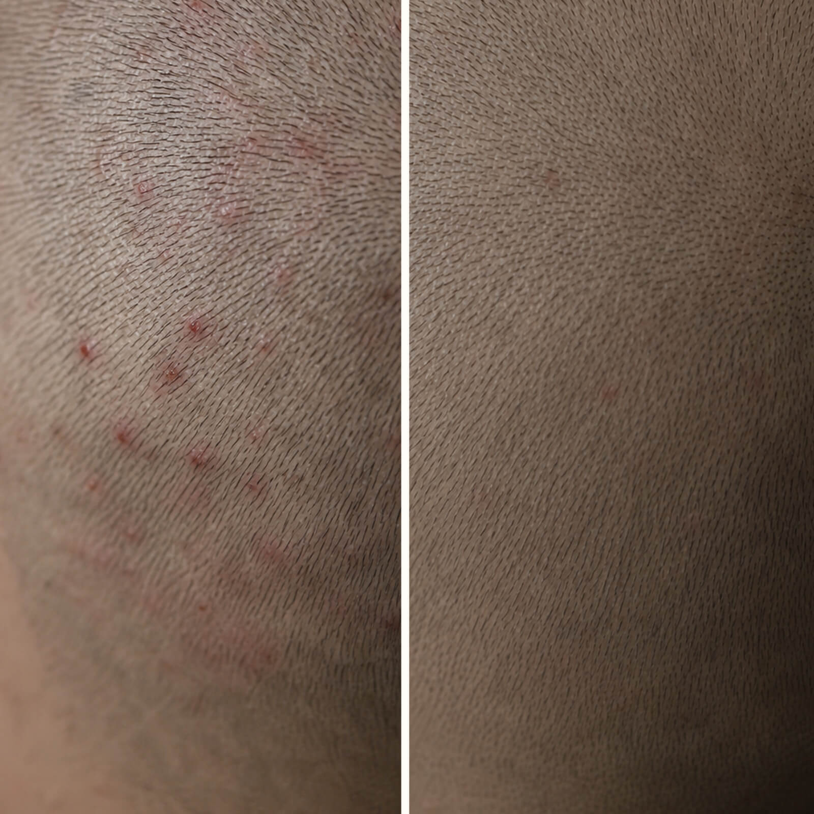 Gel de Ácido Salicílico para granos y picor en la cabeza — ¡Stop granos en el cuero cabelludo! El Ácido Salicílico exfolia los poros, reduce la grasa y calma las zonas rojas y dolorosas.