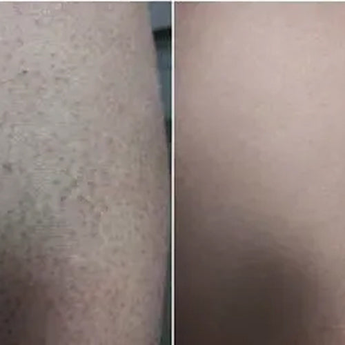 Resultado de Alena tras 2 semanas con el kit queratosis pilaris