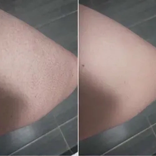 Queratosis pilaris antes y después de Alena – piel más suave tras 2 semanas