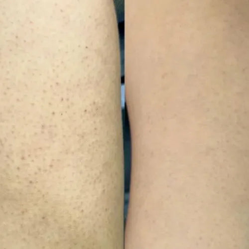 Resultado de Isabell con el kit queratosis pilaris – reducción de granitos en muslos