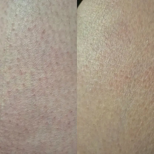 Primer plano de la piel tras tratamiento queratosis pilaris – resultado de Carolin