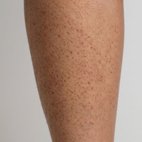 Primer plano de queratosis pilaris – pequeños granitos ásperos en los brazos