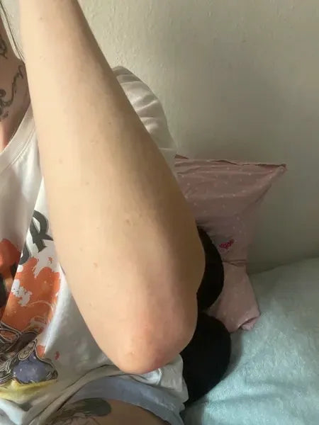 Resultado cliente queratosis pilaris – Lisa A.