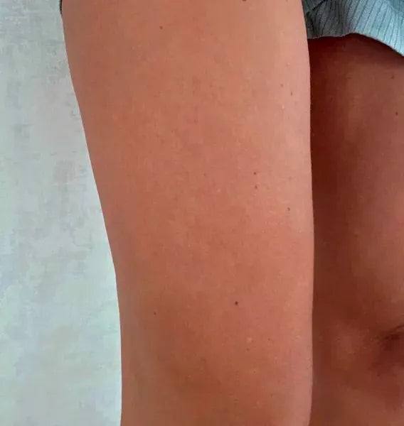 Resultado cliente queratosis pilaris – Sarah S.