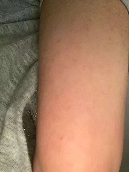 Resultado cliente queratosis pilaris – Shaian H. usa Australian Bodycare