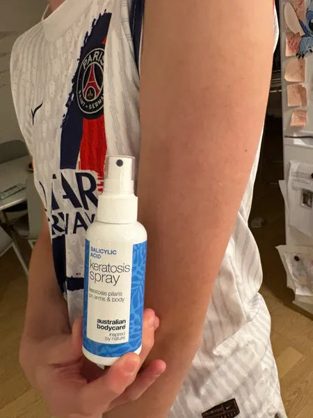 Resultado queratosis pilaris – 70% de réduction des boutons après 3 semaines